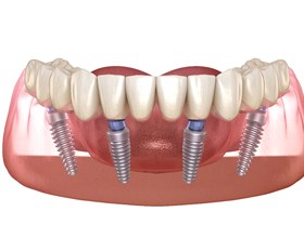 Illustration of All-on-4 dental implants in lower arch