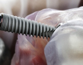 Close-up of dental implant being inserted into dental model