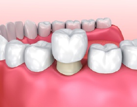 Animated porcelain dental crown being placed on lower tooth