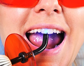 A patient getting tooth-colored fillings in Boca Raton