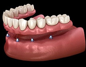 Animated dental implant supported dentures in Boca Raton
