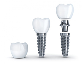 dental implant post, crown, and abutment