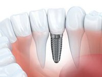 single dental implant post in the jaw