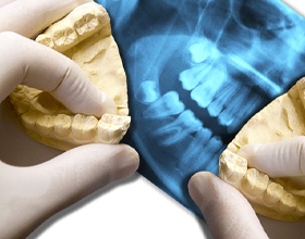 Dental model and x-rays used for occlusion dentistry