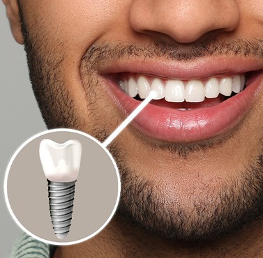 Close up of a bearded man’s smile with a complete dental implant