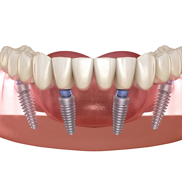 Illustration of a full denture supported by four dental implants