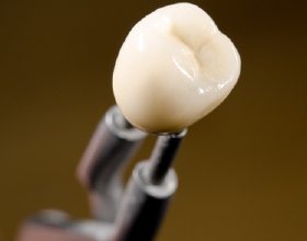 Closeup of porcelain dental crown in Boca Raton