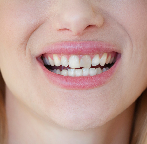 Close up of a smile with a slightly rotated front tooth
