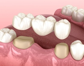 Animated smile during dental bridge placement