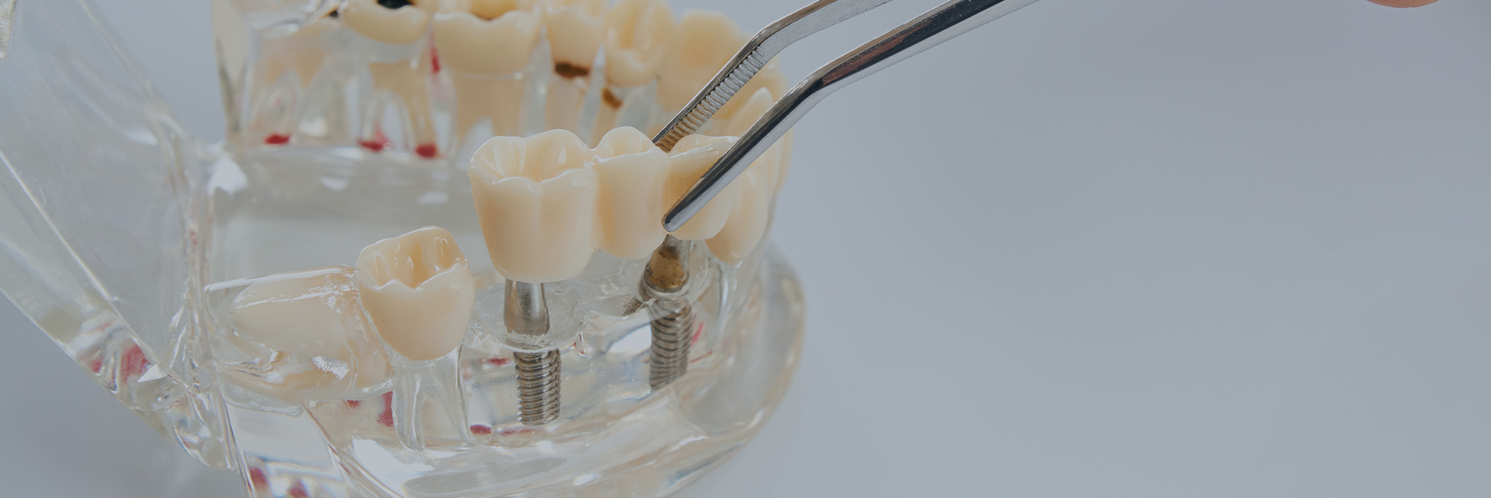 Dental bridge being placed over two dental implants in a model of the mouth