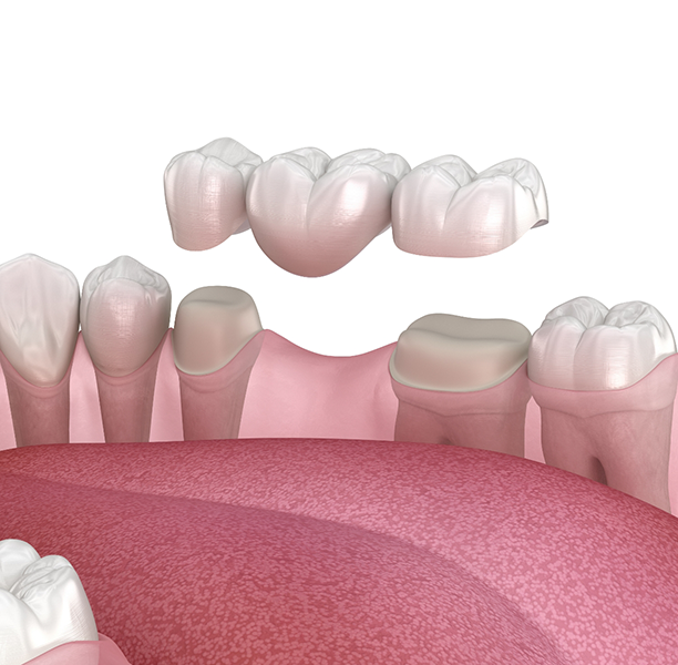 Illustration of a dental bridge replacing a missing tooth