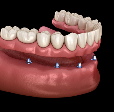 Illustration of a full denture being attached to four dental implants