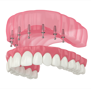 Illustration of a full denture being attached to eight dental implants