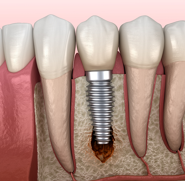 Illustration of infected jawbone tissue around a dental implant