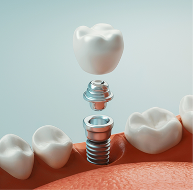 Illustration of a dental implant and crown replacing one missing tooth