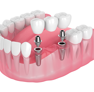 Illustration of a dental bridge and two implants replacing three missing teeth