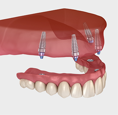 Illustration of a full implant denture on the upper arch