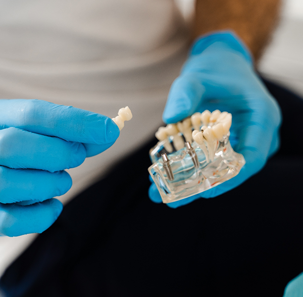 Dentist holding a dental bridge and a model of the mouth with dental implants