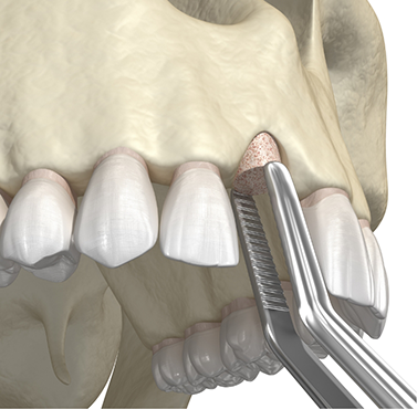 Illustration of bone grafting material being added to the upper jawbone