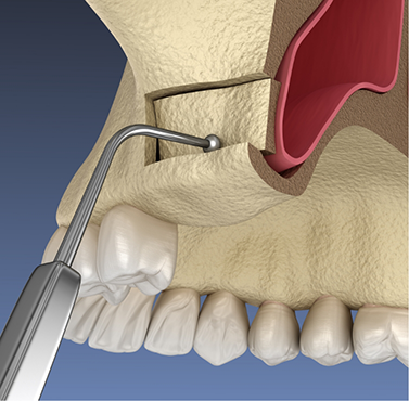 Illustration of a dental instrument gently lifting the sinus membrane