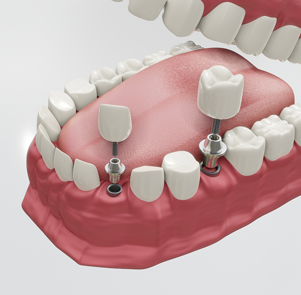 Illustration of two dental implants being restored with crowns