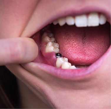 Close up of a mouth with a dental implant abutment