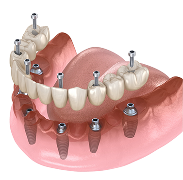 Illustration of an implant denture being placed in the lower arch