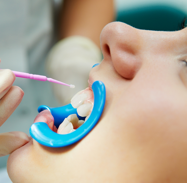 Dental patient having sealants applied to their teeth