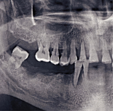 X-ray of a dental patient with multiple missing teeth