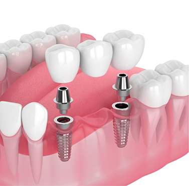 Illustration of a dental implant bridge replacing three missing teeth