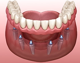 Illustration of dentures in Boca Raton, FL on dental implants
