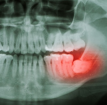 A jaw with a painful toothache