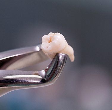 An extracted tooth in forceps