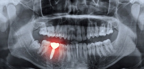 X-ray diagram of dental implant failure in Boca Raton
