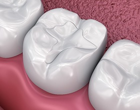 A 3D illustration of tooth-colored fillings