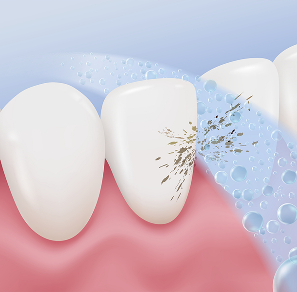 Illustration of teeth being cleaned