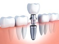 Diagram showing the different parts of dental implants in Boca Raton