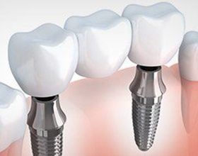 two dental implants supporting a dental bridge