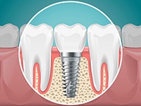 dental implant in the jawbone