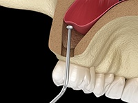 sinus lift procedure