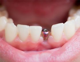 closeup of a patient with a dental implant abutment in their smile