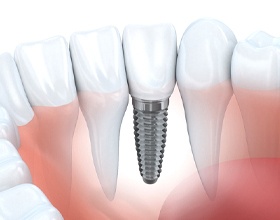 Single dental implant and crown in lower arch