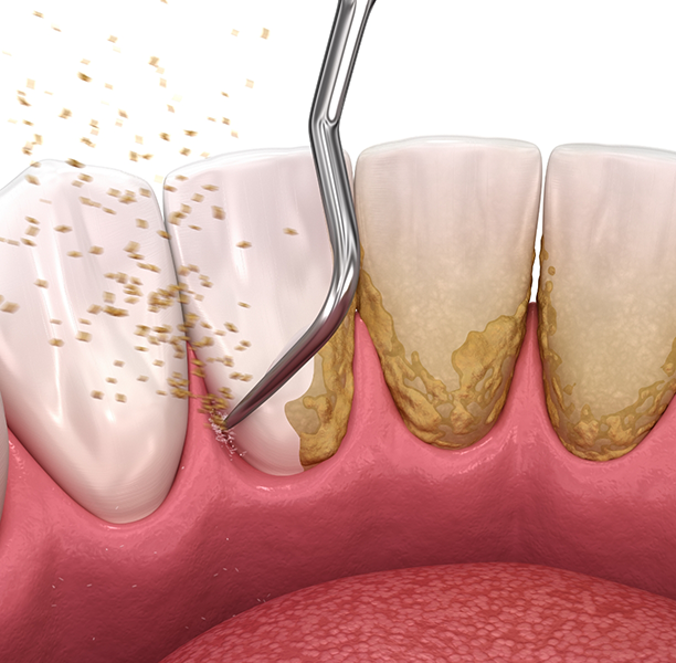 Illustration of a dental instrument clearing tartar buildup from the teeth