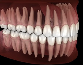 occlusion illustration?