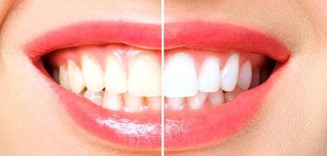 Smile before and after smile perfected teeth whitening