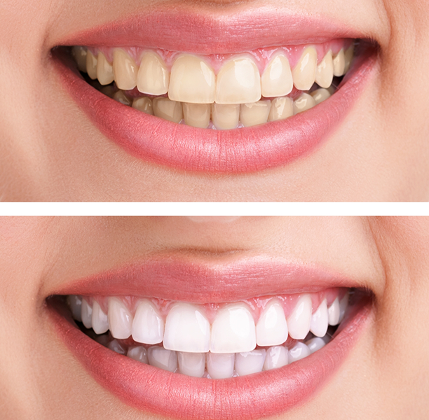 Close up of a smile before and after teeth whitening