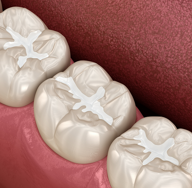 Illustration of teeth with white fillings
