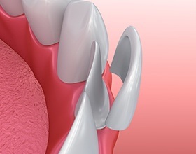 Animation of porcelain veneer placement