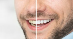 Before and after teeth whitening in Boca Raton