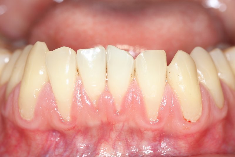 A closeup of gums that have receded